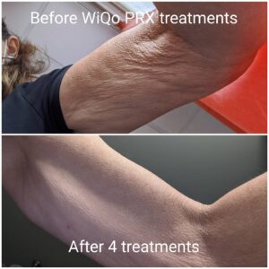 wiqo prx derm perfexion