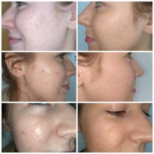 Before and After teen skin care treatments