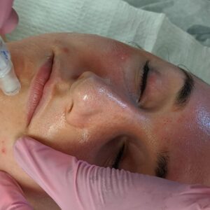 microneedling treatment