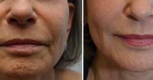 Non-Surgical Skin Tightening Before and After
