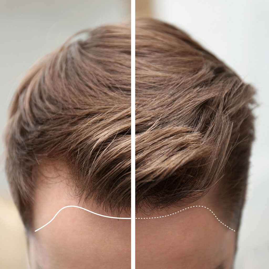 LC Cell Hair Restoration