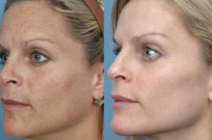 PhotoFacial - Intense Pulsed Light (IPL)