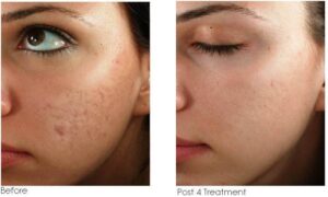 Micro-needle Acne Treatment (before and after)