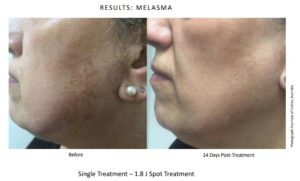 NeoGen Plasma Skin Treatment