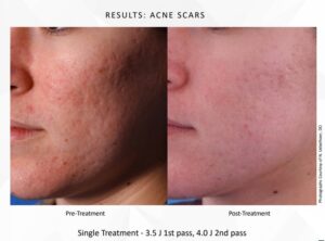 Treating Acne Scares