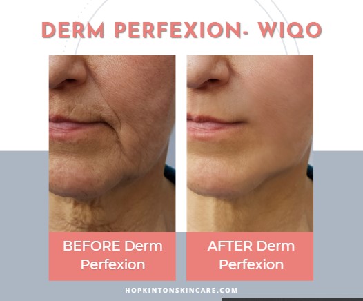 Derm Perfexion Before and After Treatment