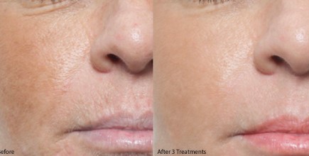 Micro-Needle Treatment Results. Before and After photos
