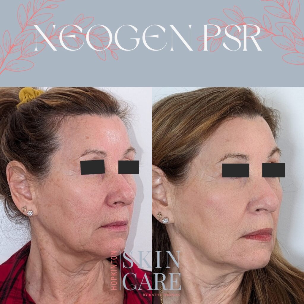 What is NeoGen PSR, and Why Should You Have This Treatment