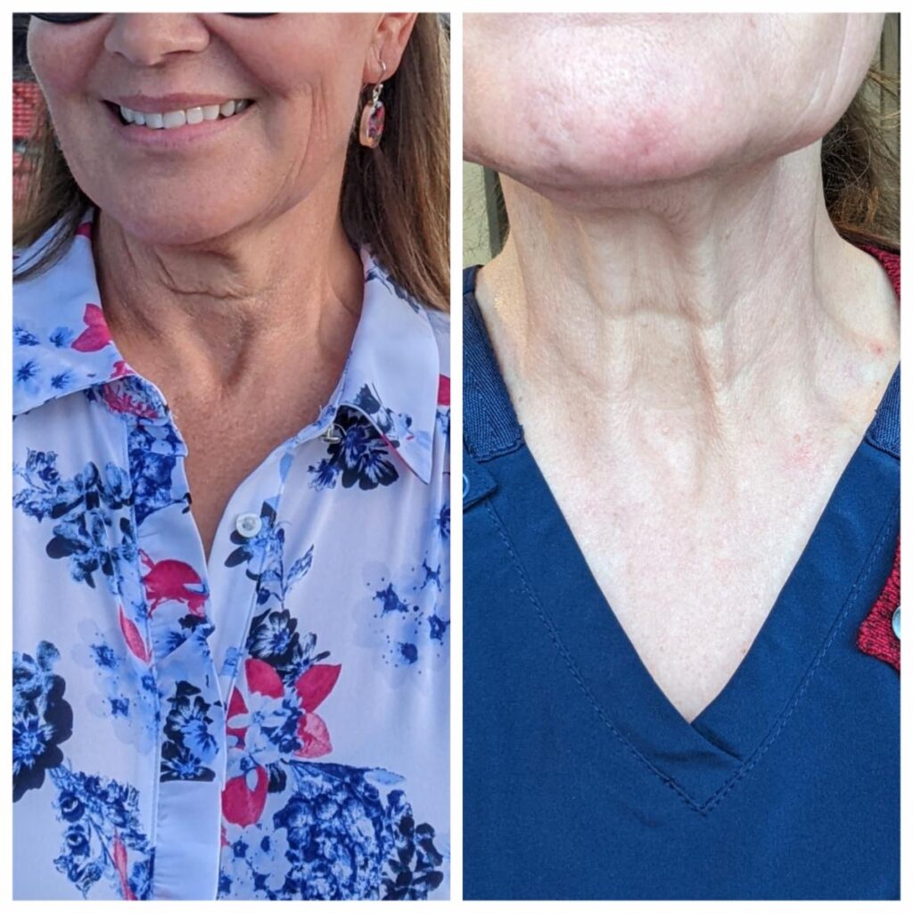neogen neck before and after