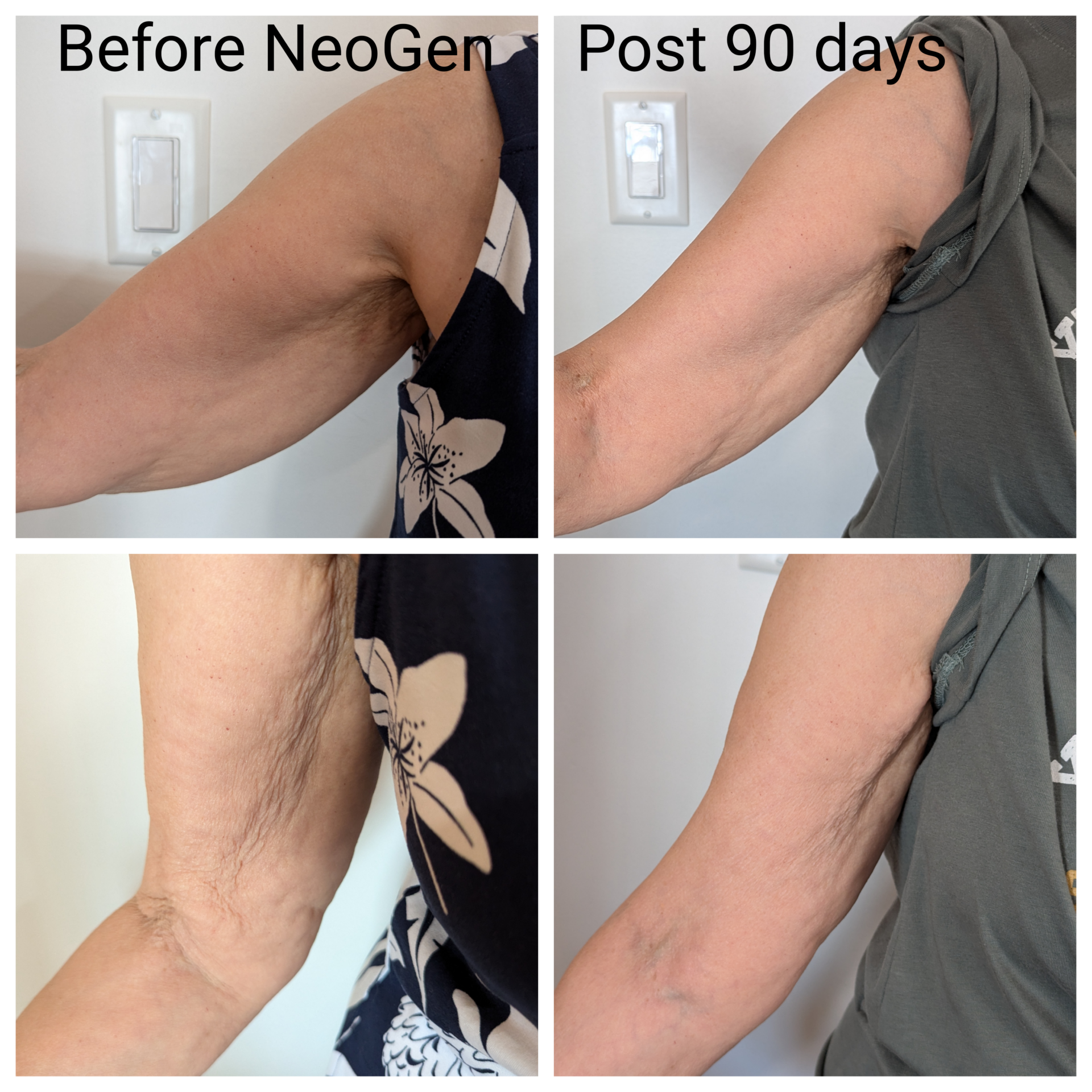 NeoGen Skin Regeneration Treatments