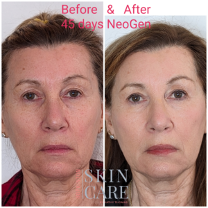 NeoGen Skin Regeneration Treatments