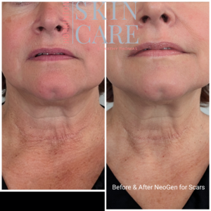 NeoGen Skin Regeneration Treatments