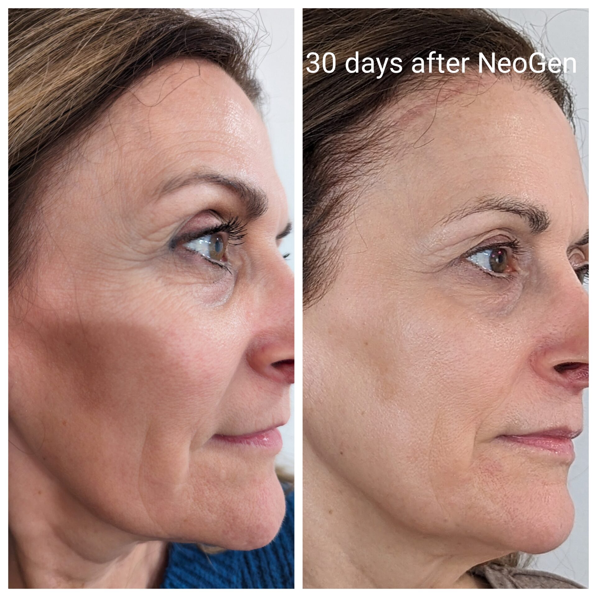 NeoGen PSR Advanced Skin Treatments