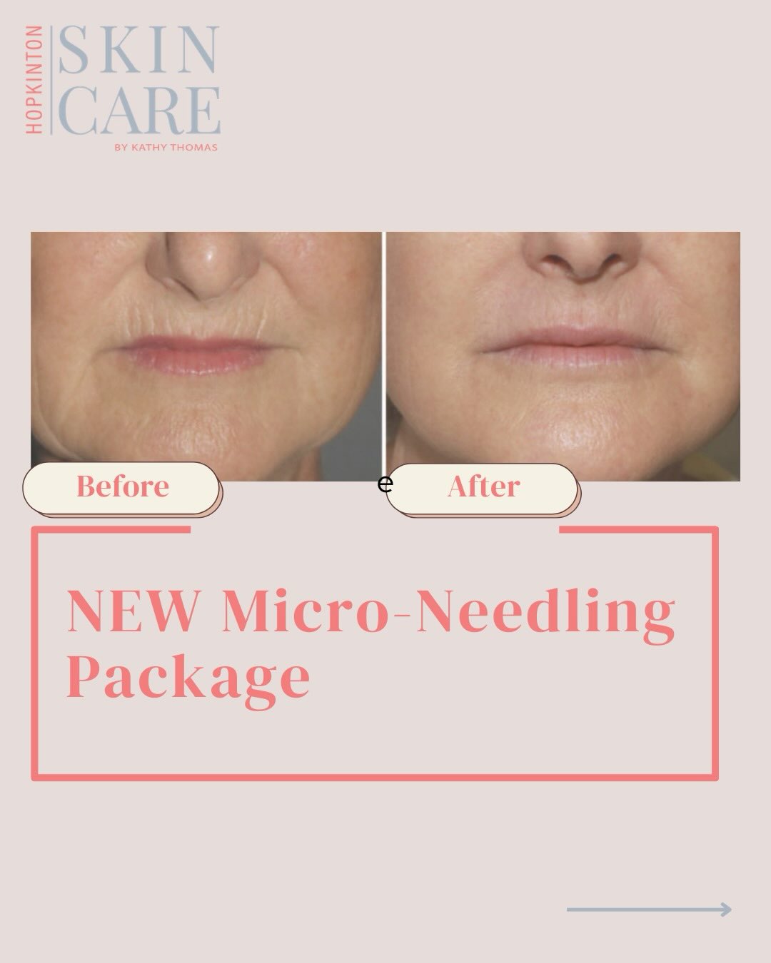Micro-Needling Package